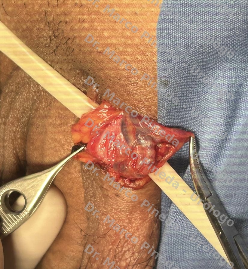 Varicocelectomía microquirúrgica caso 1