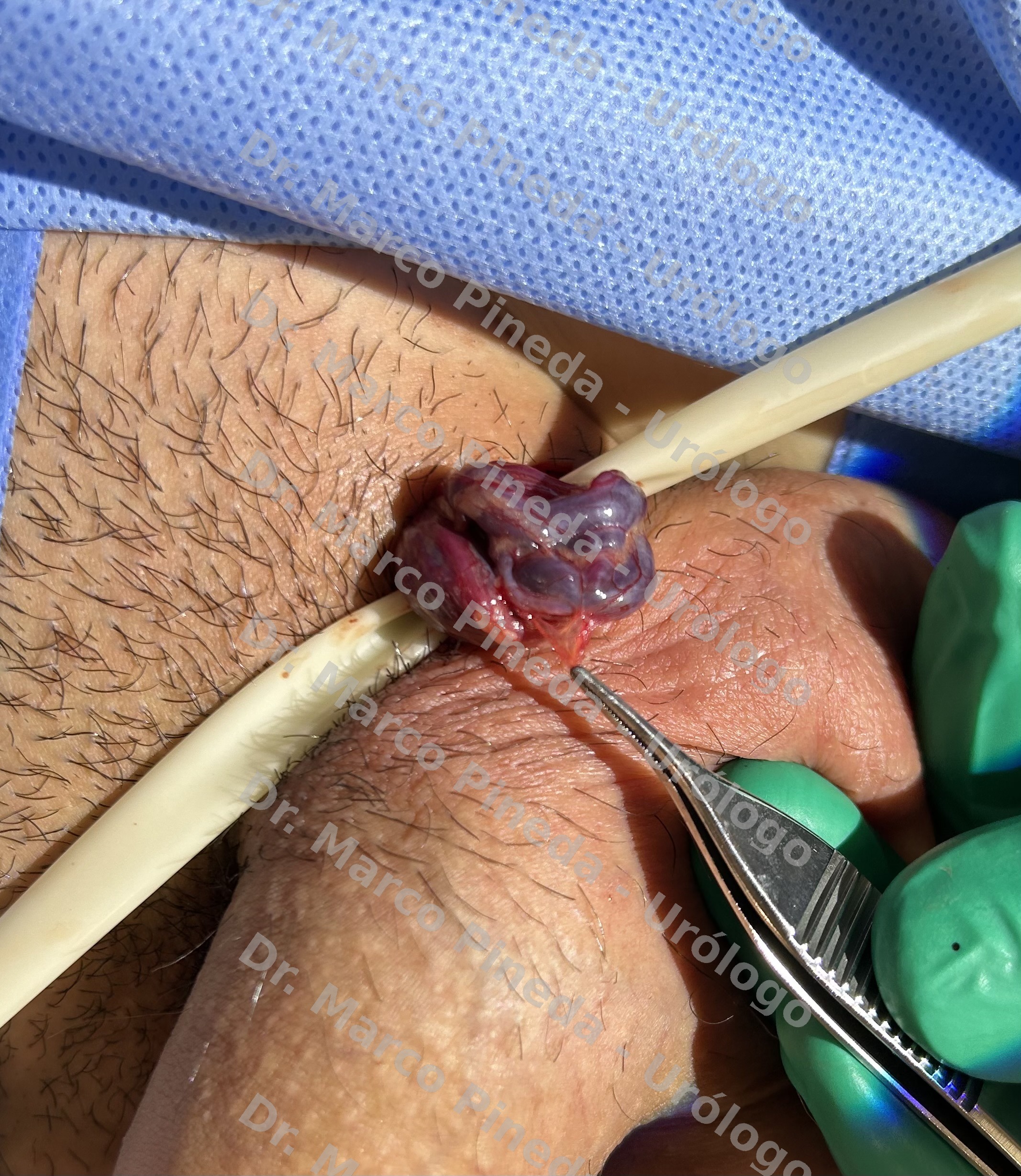 Dr. Marco E. Pineda Rodríguez — Varicocelectomía microquirúrgica en Monterrey